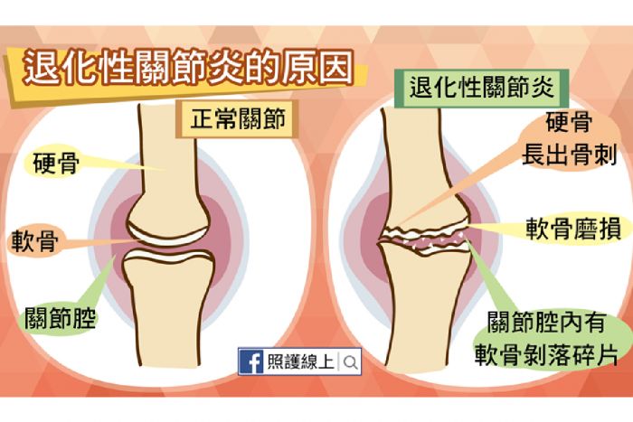 髌骨与髌骨软骨示意图.图片来源/原力复健科诊所