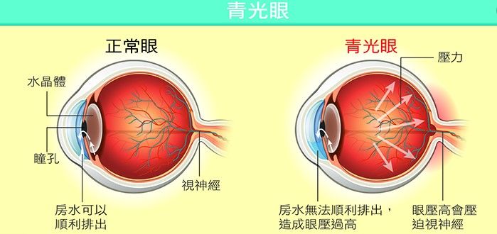 運動後視茫茫 眼脹 頭痛 噁心想吐 小心眼壓高與青光眼 健康生活 運動視界sports Vision