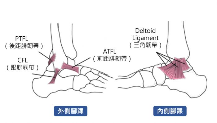 主要有三条容易受伤的韧带,分别是atfl(前距腓韧带),cfl(跟腓韧带),pt
