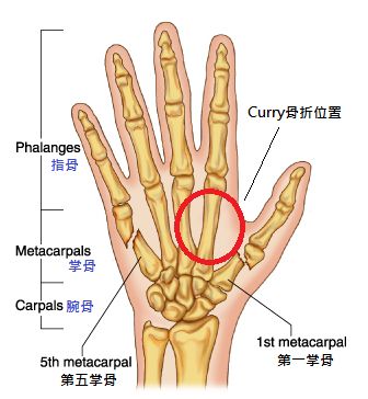 打斷手骨顛倒勇 Stephen Curry的手部骨折 與同傷勢的球員比較 Nba 籃球 運動視界sports Vision