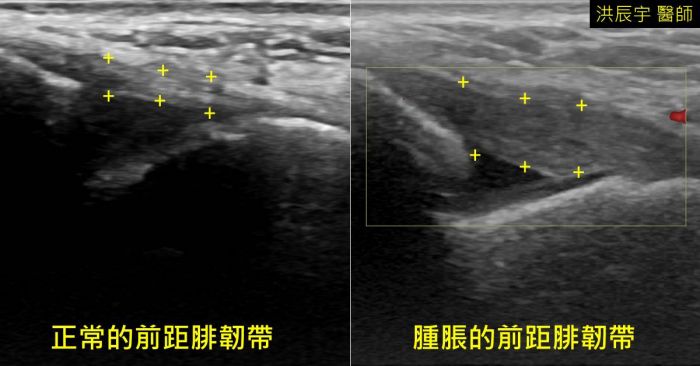 運動傷害為什麼要做肌骨超音波檢查 7 個你所不知道的好處 傷害預防 健康生活 運動視界sports Vision